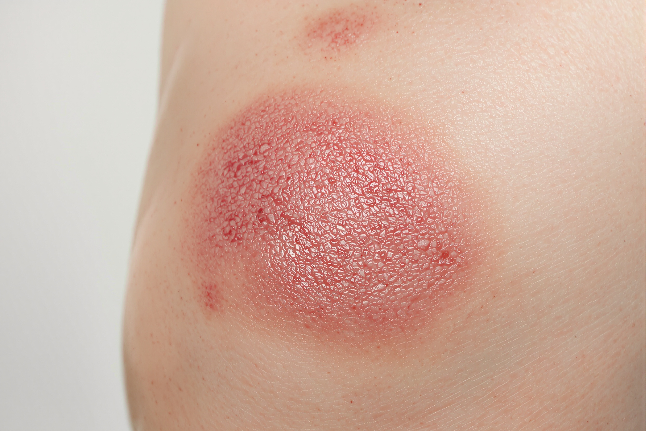 Routine de soin naturel pour psoriasis avec savon et crème