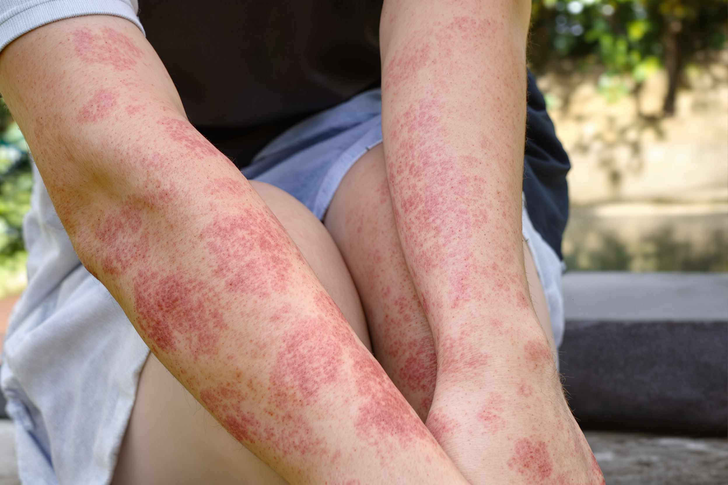 Ingrédients naturels pour traiter le psoriasis