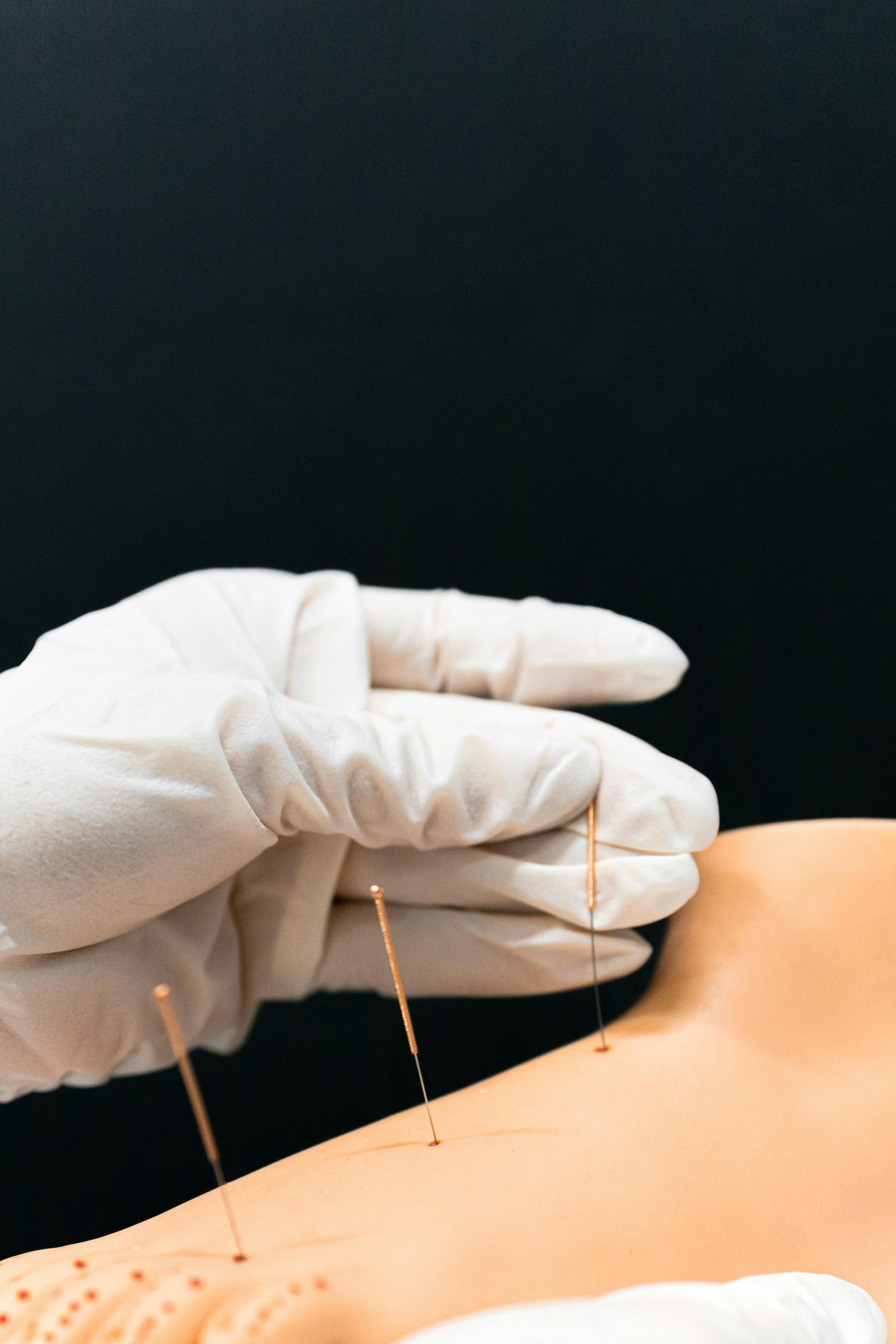 Scène de soins thérapeutiques du corps montrant des aiguilles d'acupuncture insérées dans un bras détendu, mettant l'accent sur le bien-être, le soulagement de la douleur et les techniques de traitement manuel.